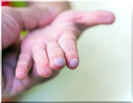 Blisters in children: how to treat them