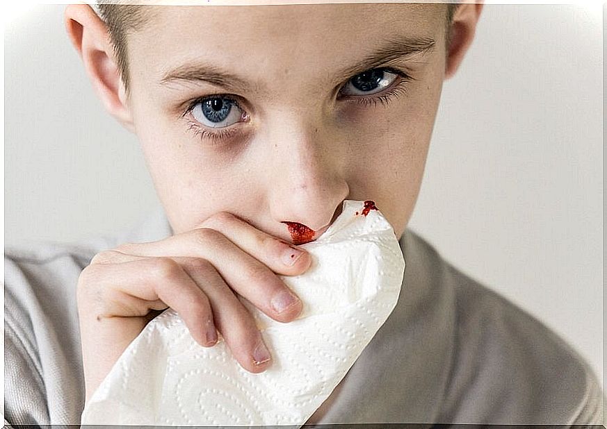 Epistaxis in children: causes and treatment