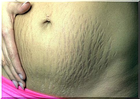 Help with stretch marks - tips to combat