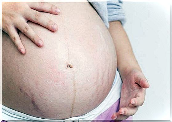 Prevention against stretch marks during pregnancy